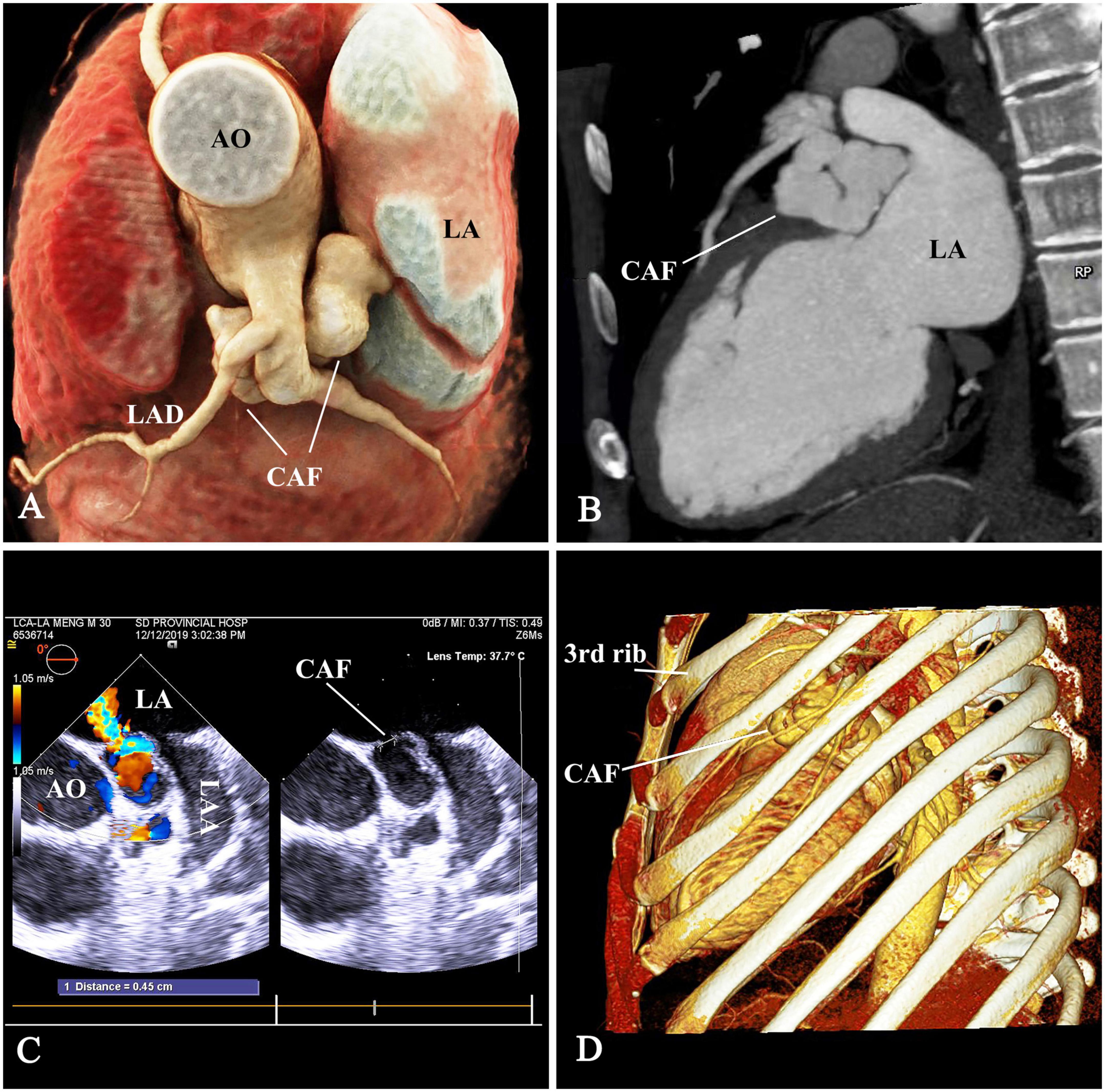 Case report: Percoronary device closure of tortuous coronary artery fistula into left atrium